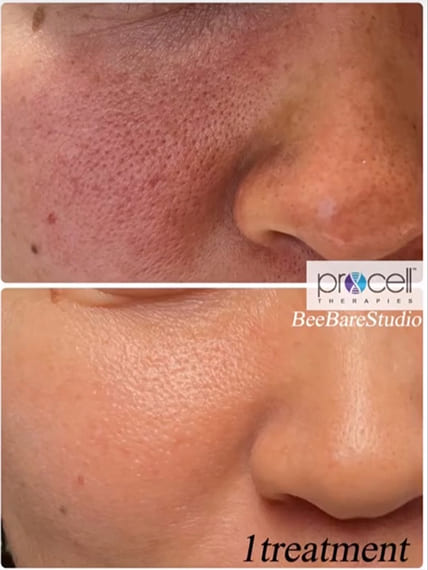 頬や鼻の赤み・毛穴開きの改善例