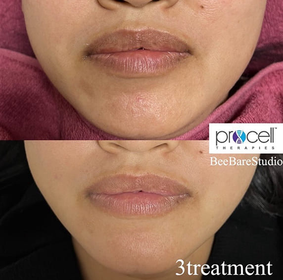 顔下半分の肌質改善例