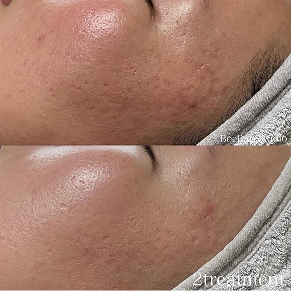 頬の赤みやニキビ跡の改善例