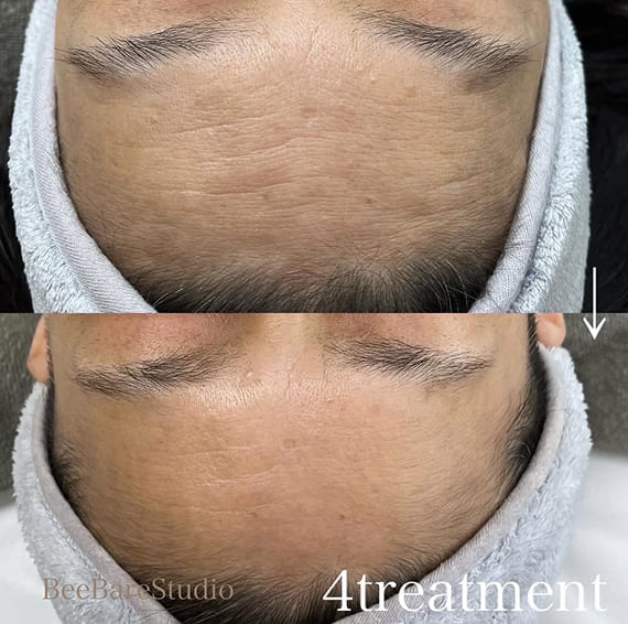 おでこのシワ改善とトーンアップの例