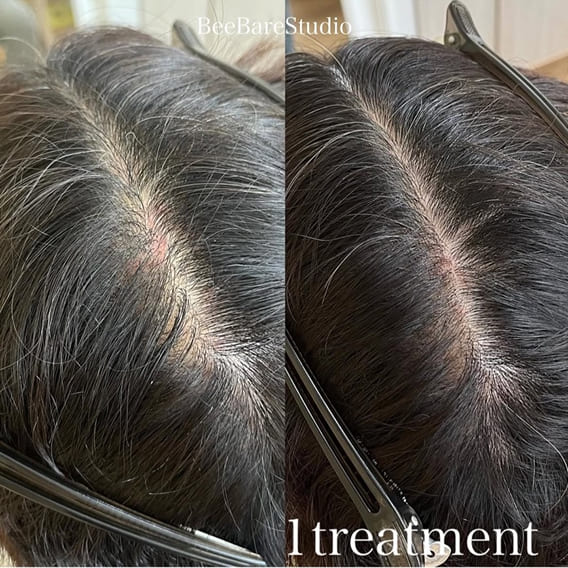 頭頂部分け目の薄毛改善例