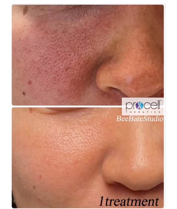 赤み・毛穴開き 改善例