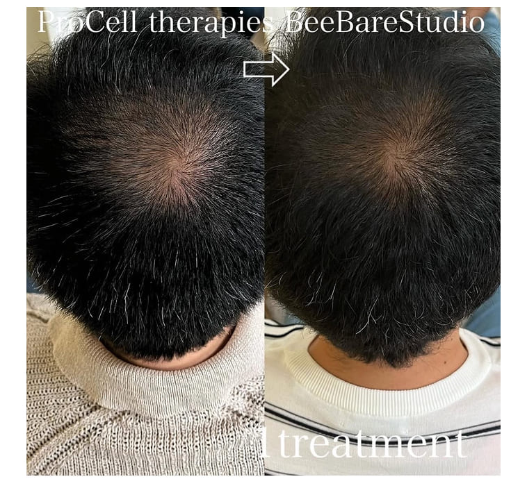 頭頂部のボリューム 改善例