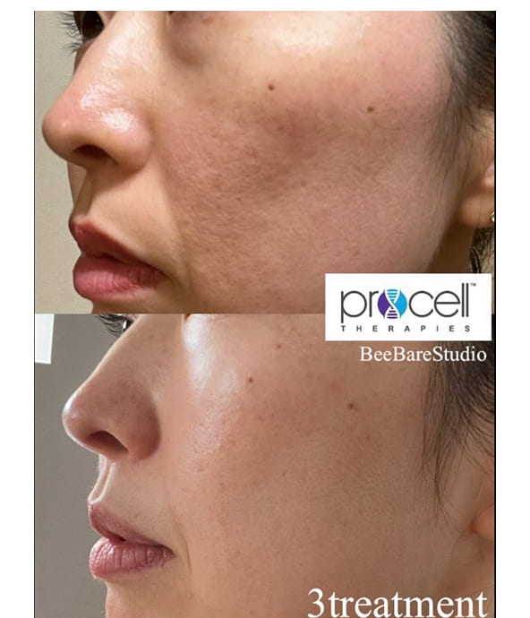 ニキビ跡 改善例