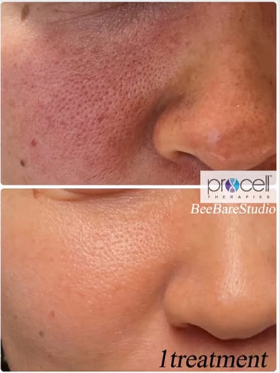 肌質改善 施術1回のビフォーアフター（30代女性）