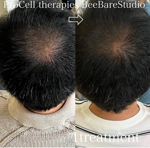 頭皮ケア 施術1回のビフォーアフター（40代男性）