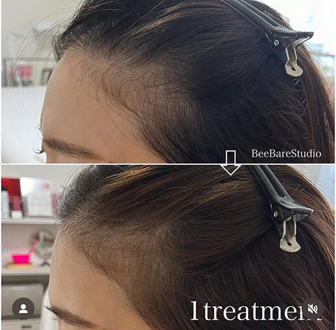 頭皮ケア 施術1回のビフォーアフター（30代女性）