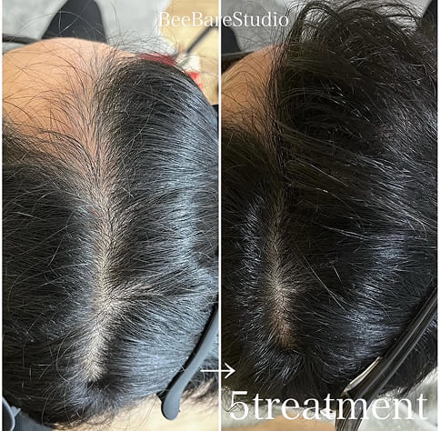 頭皮ケア 施術5回のビフォーアフター（40代女性）